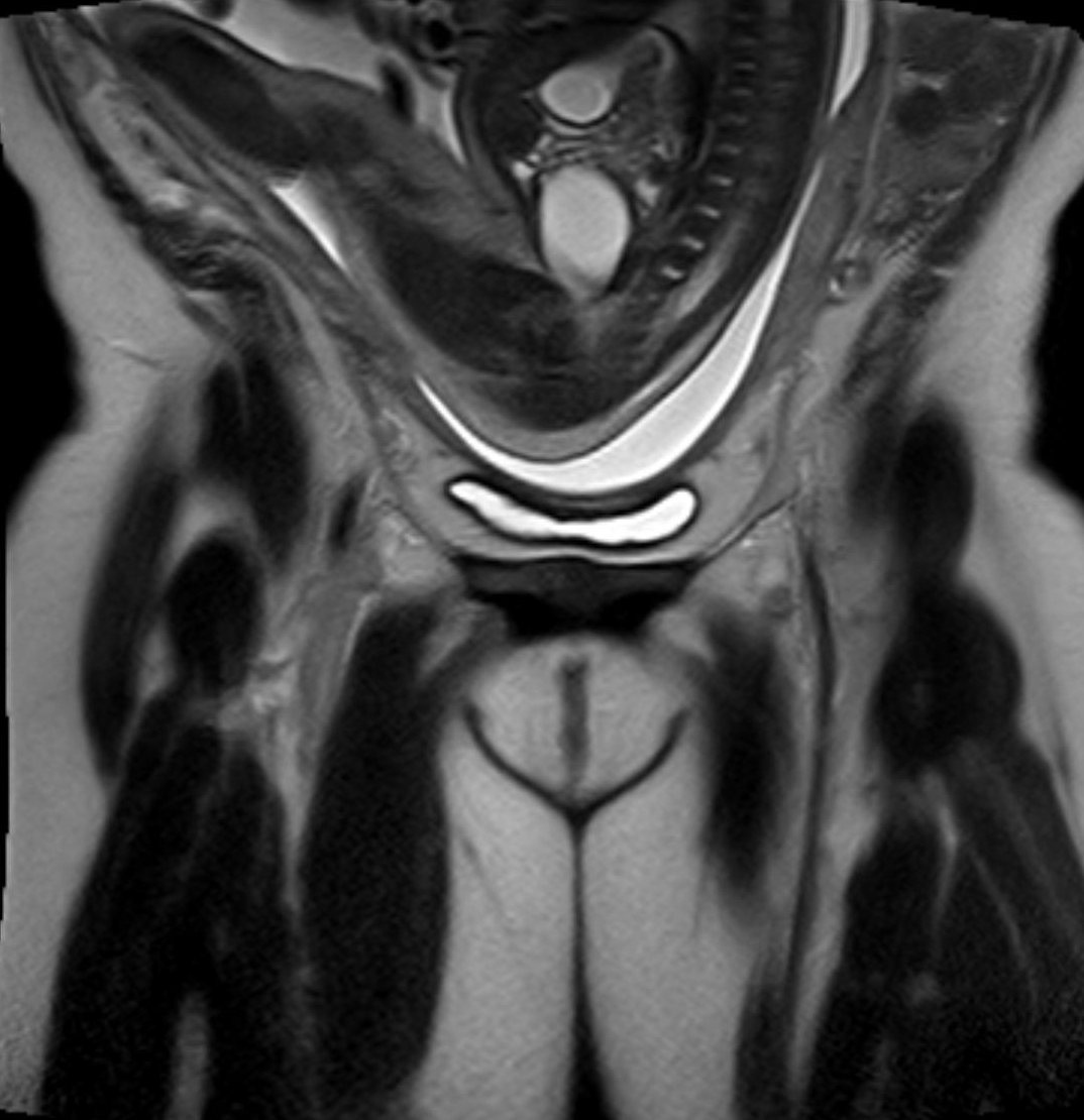 Breech baby superstitions image