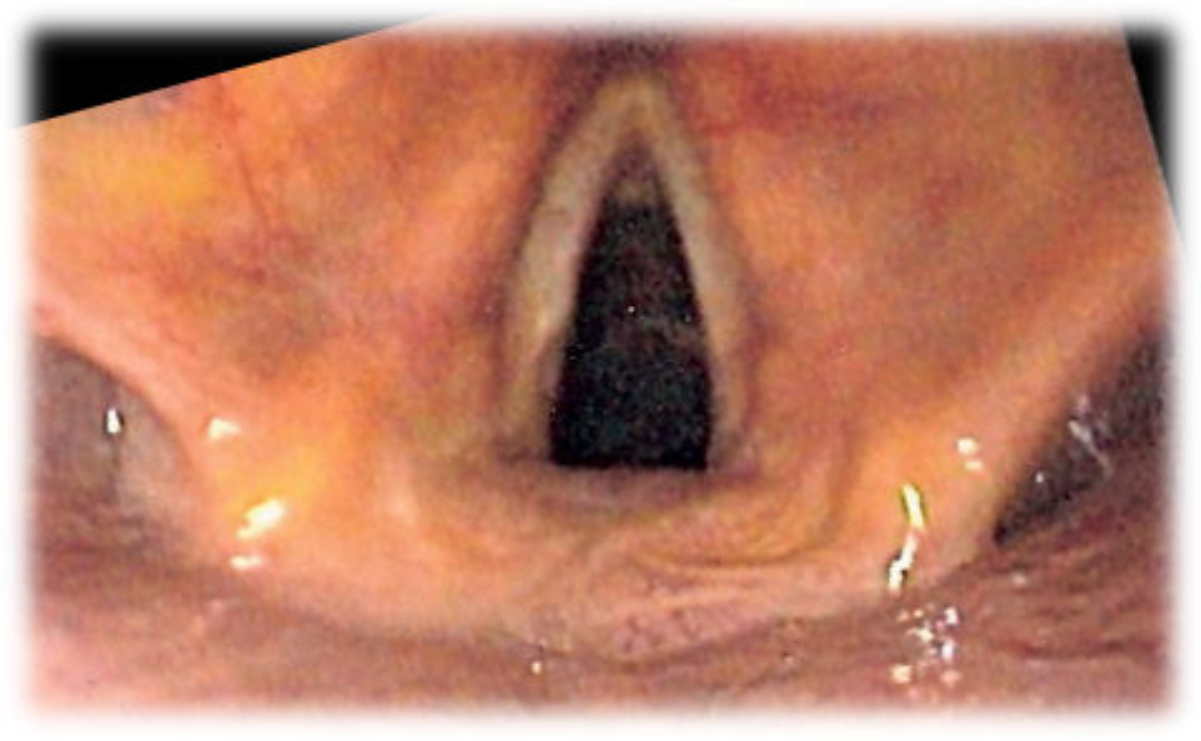 View of the <a href="/content/Glottis" style="color:blue">glottis</a> as seen during laryngoscopy